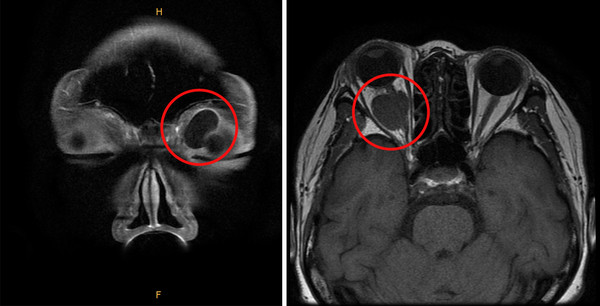 왼쪽 안와 앞쪽에 생긴 낭성 종괴(왼쪽)와 오른쪽 안와 뒤쪽에 생긴 시신경 종양.